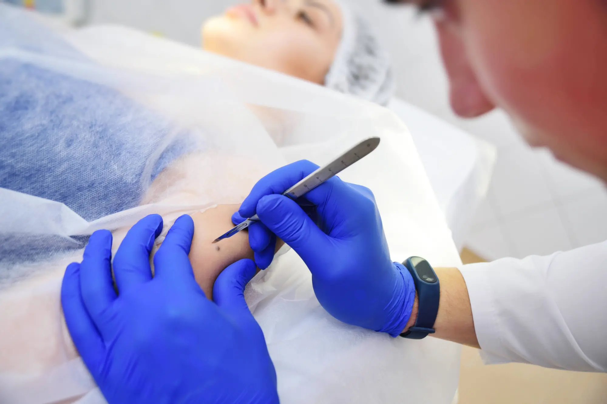 mole removal